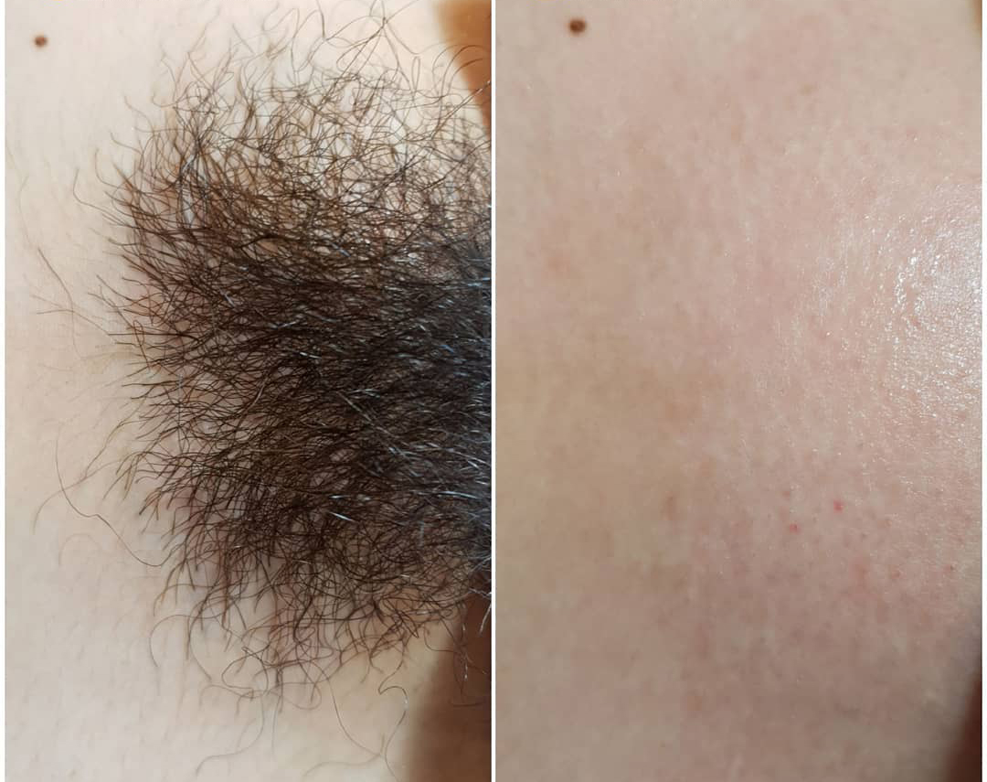 Triệt Lông Bikini Tại Sen Beauty